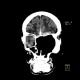 Gigantic defect in face after resection of carcinoma: CT - Computed tomography